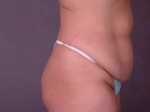 Liposuction Before and after photo