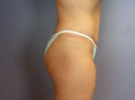 Liposuction Before and after photo