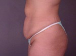 Liposuction Before and after photo