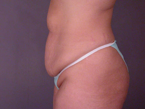 Liposuction before and after photo