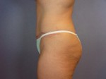 Liposuction Before and after photo