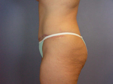 Liposuction before and after photo