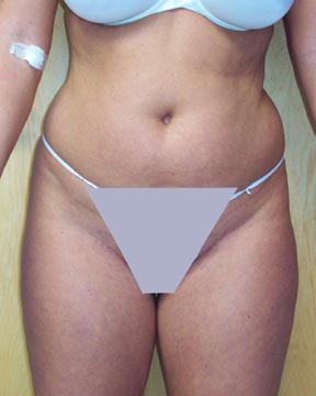 Liposuction before and after photo