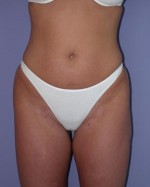 Liposuction Before and after photo