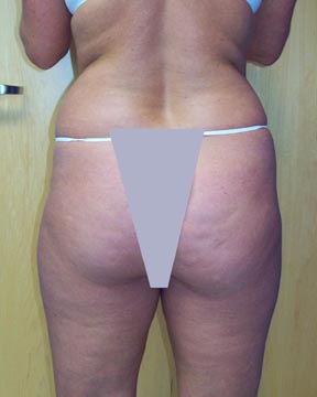 Liposuction before and after photo