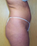 Liposuction Before and after photo