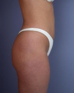 Liposuction Before and after photo