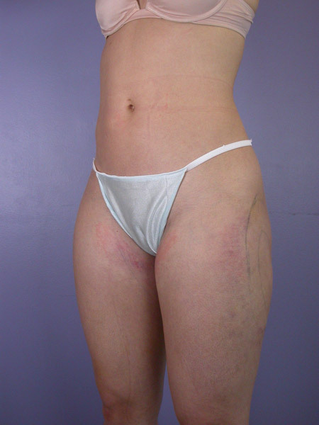 Liposuction before and after photo