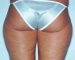 Liposuction Before and after photo