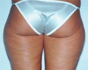 Liposuction before and after photo