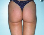 Liposuction Before and after photo