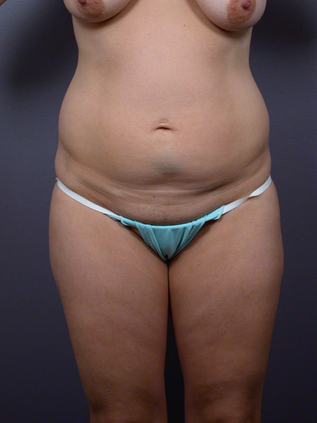 Liposuction before and after photo