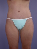 Liposuction Before and after photo