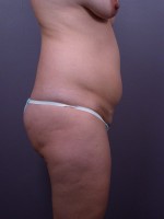 Liposuction Before and after photo