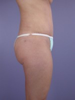 Liposuction Before and after photo