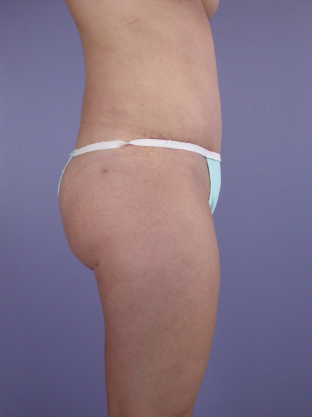 Liposuction before and after photo