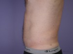 Liposuction Before and after photo