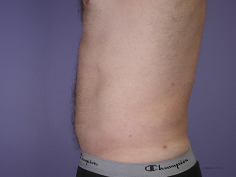 Liposuction before and after photo