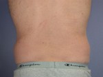 Liposuction Before and after photo