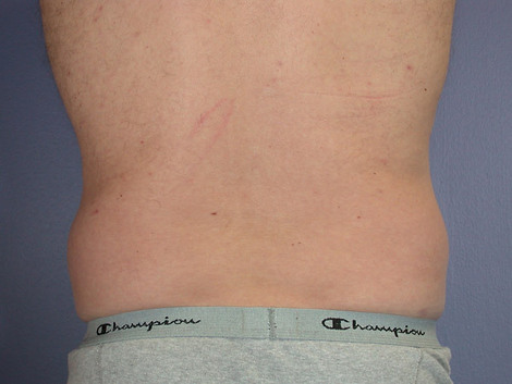 Liposuction before and after photo