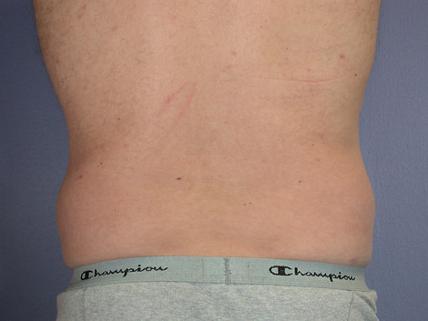 Liposuction before and after photo