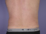 Liposuction Before and after photo