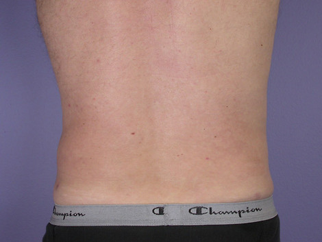 Liposuction before and after photo