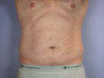 Liposuction Before and after photo