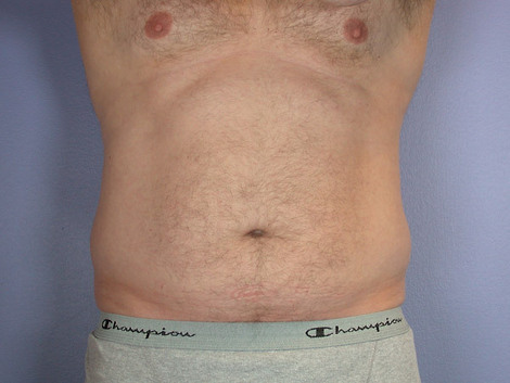 Liposuction before and after photo