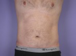 Liposuction Before and after photo