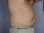 Liposuction Before and after photo