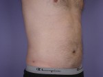 Liposuction Before and after photo