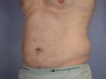 Liposuction Before and after photo