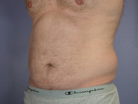 Liposuction before and after photo