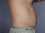 Liposuction Before and after photo