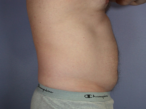 Liposuction before and after photo