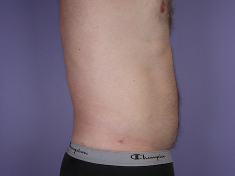 Liposuction before and after photo