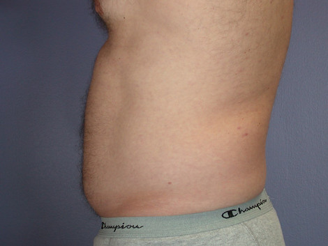 Liposuction before and after photo