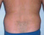 Liposuction Before and after photo