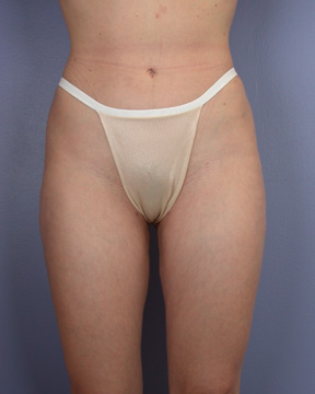 Liposuction before and after photo