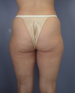 Liposuction Before and after photo