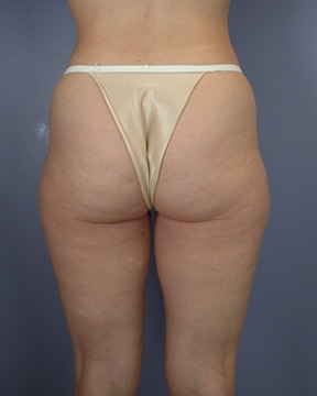 Liposuction before and after photo