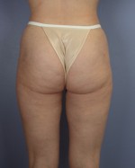 Liposuction Before and after photo