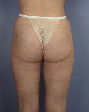 Liposuction before and after photo