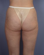 Liposuction Before and after photo