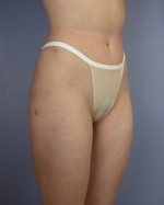 Liposuction Before and after photo