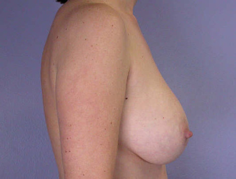 Liposuction before and after photo