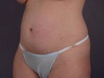 Liposuction Before and after photo