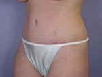 Liposuction Before and after photo