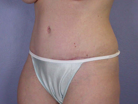 Liposuction before and after photo